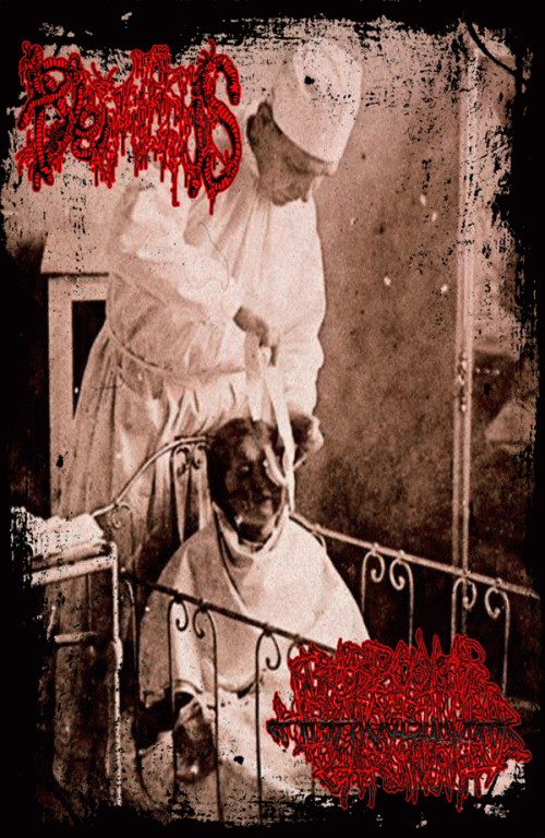 Trabecular Hepatocellular Carcinoma : Pyemesis - Trabecular Hepatocellular Carcinoma